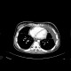 Pleural effusion, loculated: CT - Computed tomography